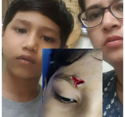 Benefit of cosmetic suturing of CLW scarless